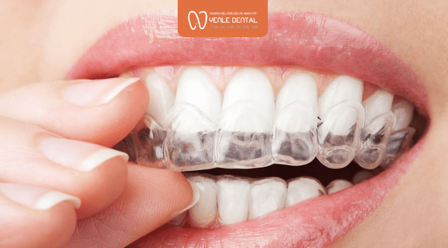 mặt lệch khi niềng răng phải làm sao